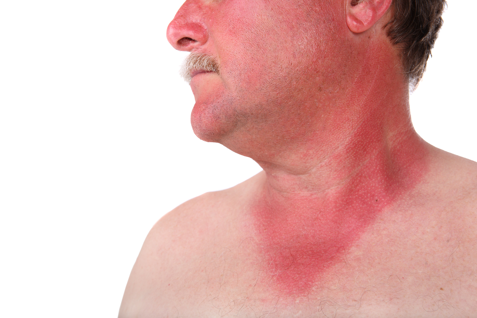 Sunburns And Energy Science Medicine Dr Bill Dean