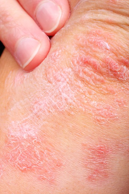 Bigstock_Patient_With_Psoriasis_3027198